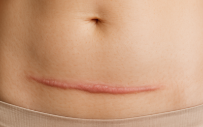 Caesarean Scars – How to Continue Healing after Delivery